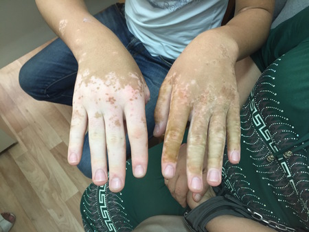 Master Class Vitiligo Kazakhstan 2016 14
